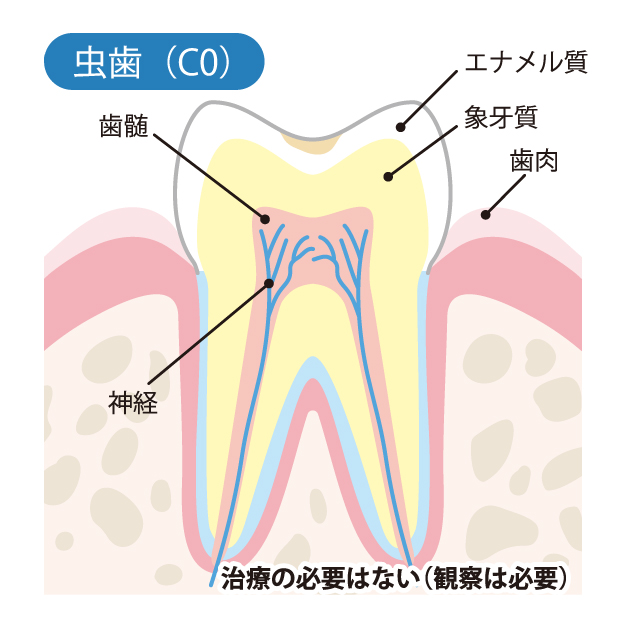 柏市(逆井)の歯医者、伊藤歯科クリニックで虫歯治療