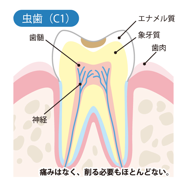 柏市(逆井)の歯医者、伊藤歯科クリニックで虫歯治療