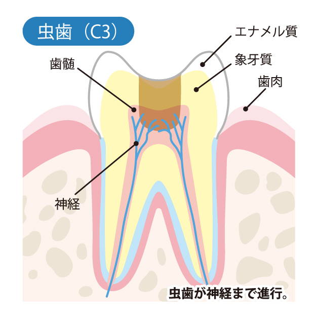 柏市(逆井)の歯医者、伊藤歯科クリニックで虫歯治療