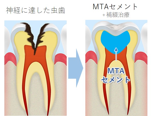 柏市(逆井)の歯医者、伊藤歯科クリニックのMTAセメント